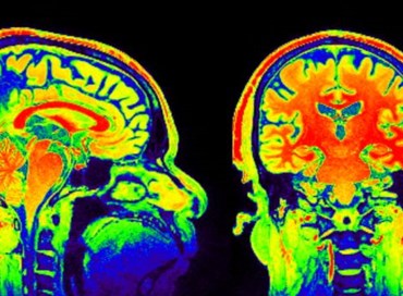 Neuro-imaging per curare l’Alzheimer