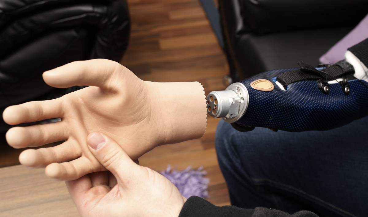 Una mano bionica è stata impiantata su una donna italiana 