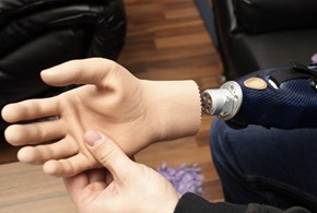 Una mano bionica è stata impiantata su una donna italiana 