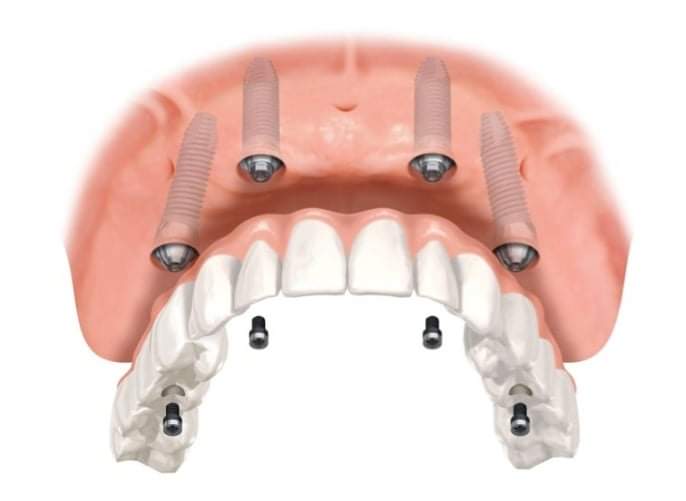 “L’Opinione risponde”: la tecnica all-on-4	