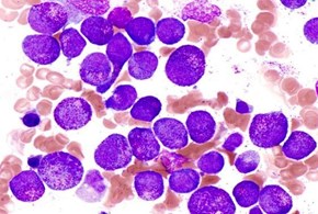 Nuova speranza di cura per la leucemia linfoblastica acuta
