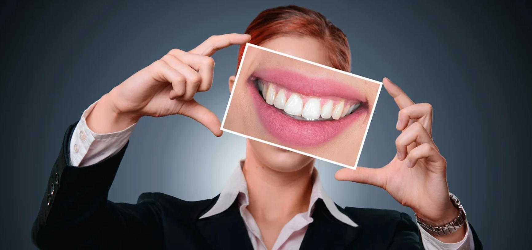 L’Opinione risponde: le faccette dentali